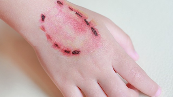 Tetanus – jak se přenáší, a jak se mu vyhnout?